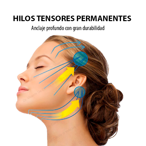 Hilos Tensores cirujano