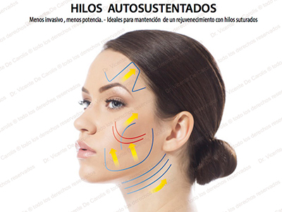 Hilos Tensores cirujano