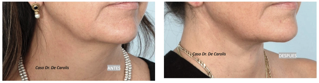 Lifting de cuello con hilos tensores y liposucción por el Dr. De Carolis: vista semiperfil.