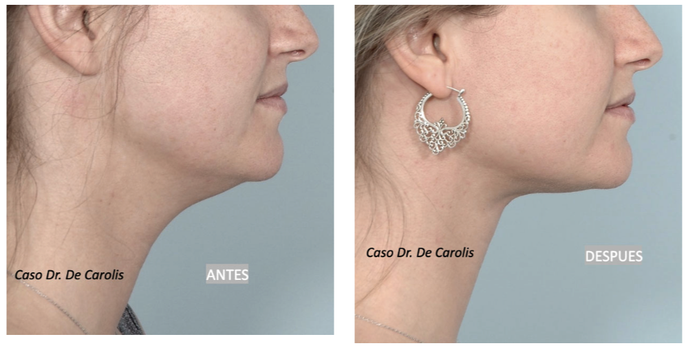 Definición y armonización del perfil con hilos tensores en un cuello joven por el Dr. De Carolis.