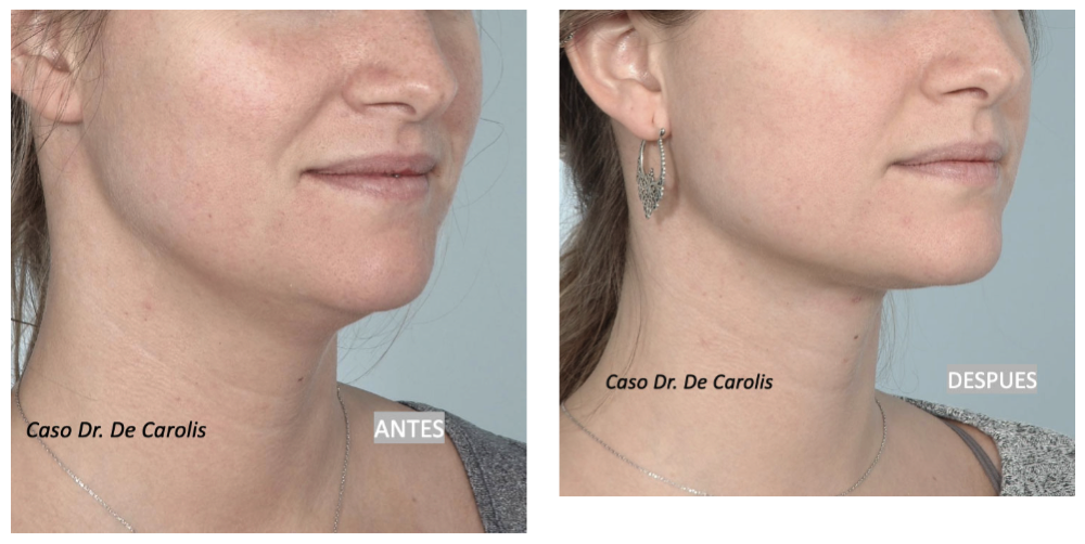 Definición y armonización del cuello con hilos tensores: vista semiperfil.