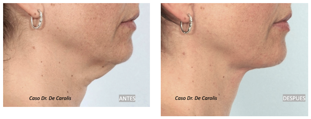 Corrección de hiperlaxitud en un cuello joven con minilifting mas hilos tensores por el Dr. De Carolis.