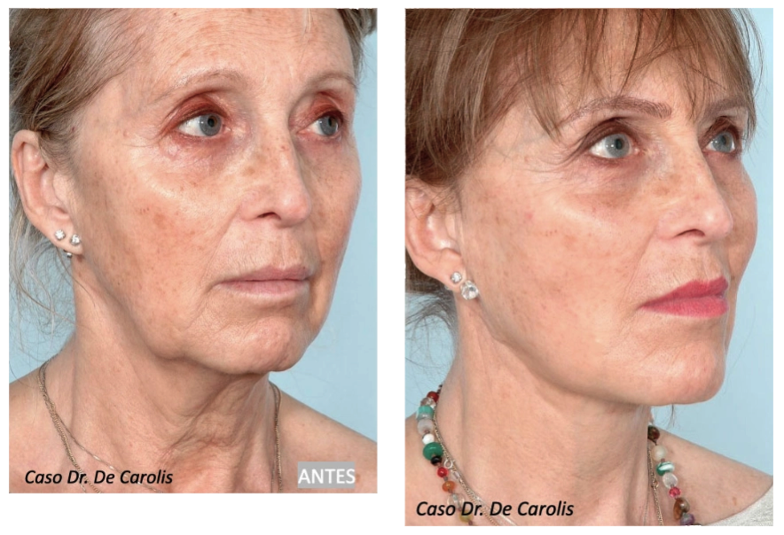 Lifting facial total con hilos tensores permanentes por el Dr. De Carolis: vista semiperfil