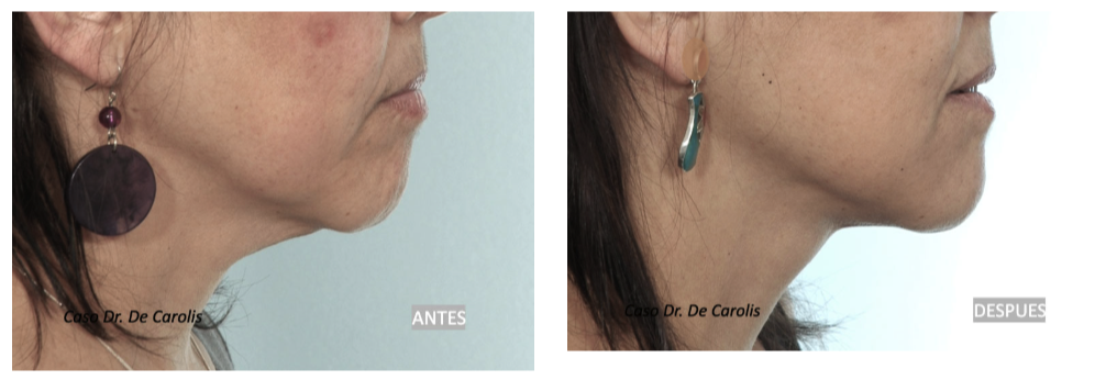 Redefinición facial con hilos tensores y volumen mandibular por el Dr. De Carolis.