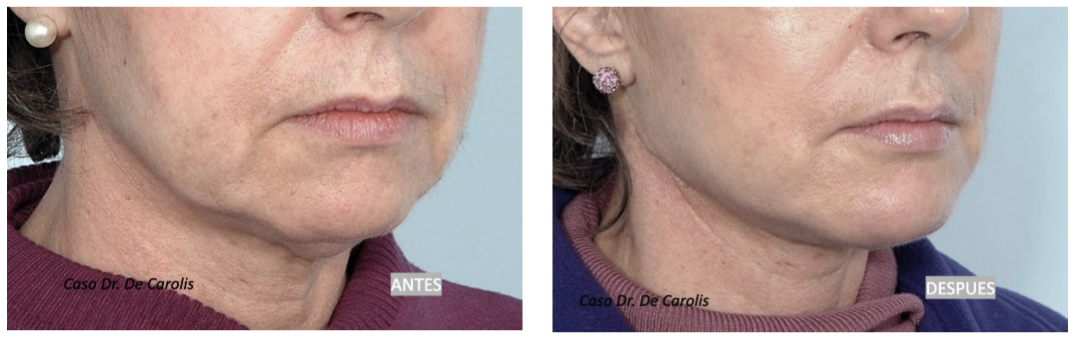 Redefinición mandibular y firmeza en el cuello con hilos tensores permanentes por el Dr. De Carolis
