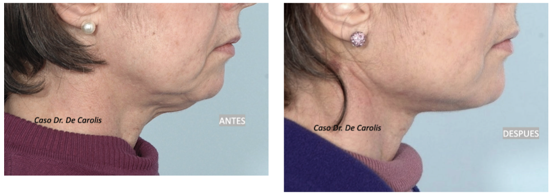 Redefinición mandibular y firmeza en el cuello con hilos tensores: vista perfil.