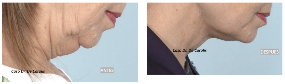 Rejuvenecimiento facial y cuello con hilos tensores permanentes: vista perfil en flexión.