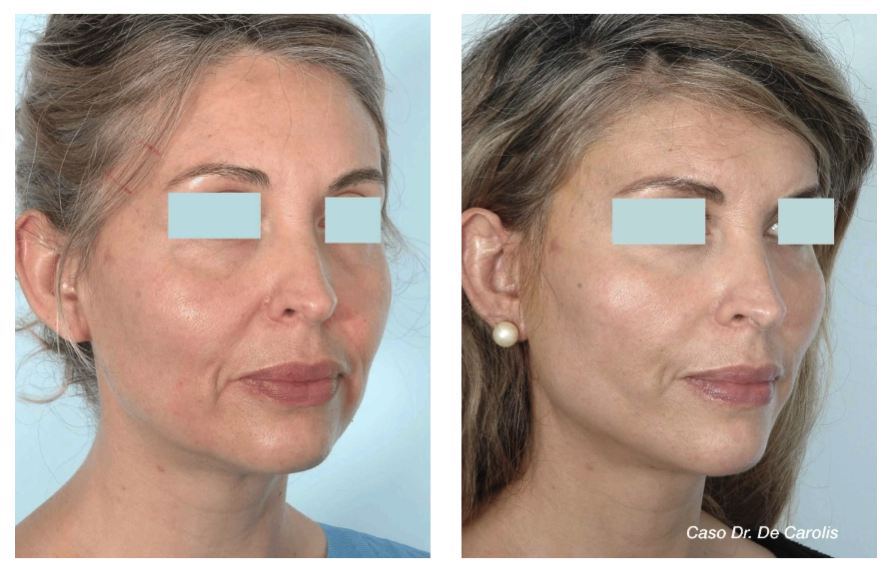 Rejuvenecimiento facial con hilos tensores permanentes por el Dr. De Carolis: redefinición del óvalo facial
