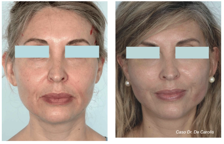 Rejuvenecimiento facial con hilos tensores permanentes por el Dr. De Carolis: redefinición óvalo facial. Vista de frente.