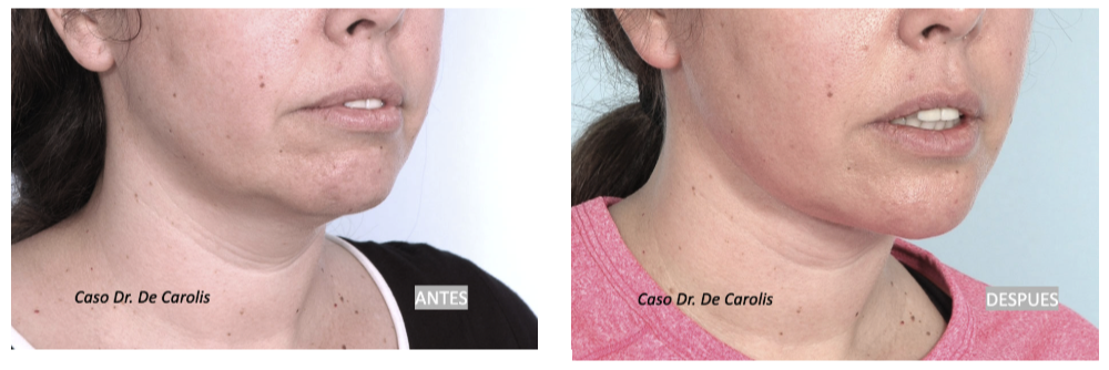 Cuello estilizado con hilos tensores y mentoplastía: vista semiperfil.