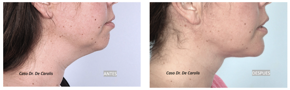 Transformación del perfil con hilos tensores y mentoplastia por el Dr. De Carolis: cuello estilizado y mandíbula definida